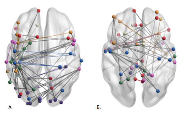 Dati preliminari mostrano un aumento di connettività cerebrale dopo un trattamento con MindLenses.